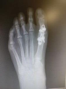 Pros and Cons of Big Toe Joint Fusion: *It is the most reliable surgery!*