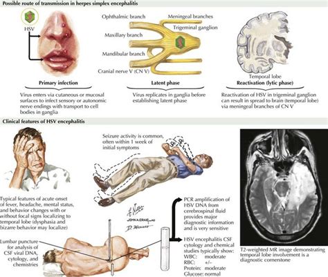 Encephalitis Lethargica Cause Symptoms Diagnosis