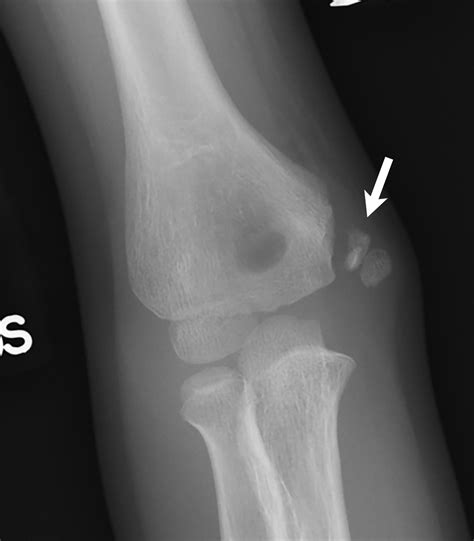 Elbow Grease Lateral And Medial Condyle Fractures Of The Humerus | The Best Porn Website