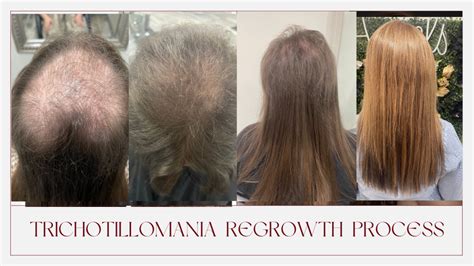 Trichotillomania Regrowth Strategies Boston, MA – noellesalon