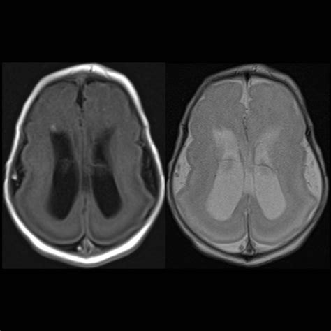 Newborn with hydrocephalus on prenatal ultrasound | Pediatric Radiology Case | Pediatric Imaging ...