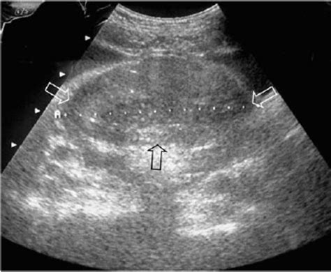 Pelvic ultrasound shows a 8 cm solid,heterogeneous, pelvic mass (arrow)...