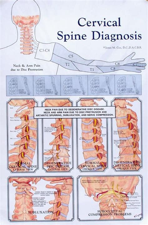 Cervical Spine Diagnosis Anatomy Poster - Clinical Charts and Supplies