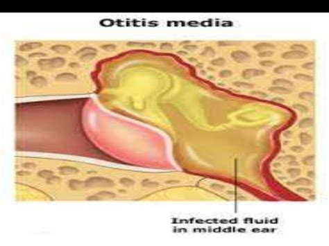 Acute suppurative otitis media