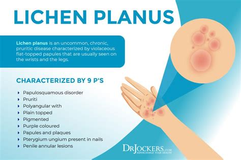 lichen sclerosus penile treatment - Zane Brothers