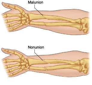 Malunion | Heath & Education