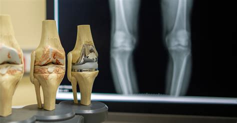 Exactech Knee Replacement Lawsuits | The Cartwright Law Firm, Inc.