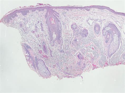 Actinic prurigo | Dermpedia