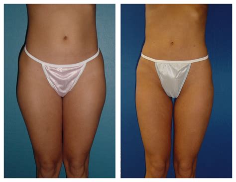 Female Inner & Outer Thighs Liposuction by Dr. William Hall Before and ...