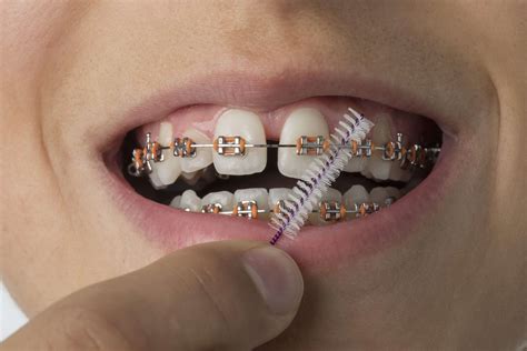 Traditional Braces in Richardson, Texas | Pros, Cons, Cost