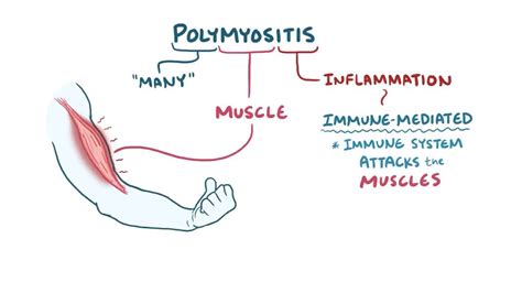 Polymyositis Types Causes Symptoms Complications Diagnosis Treatment – NBKomputer