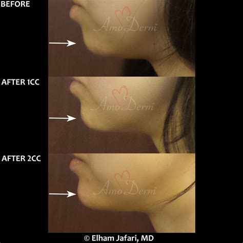 Irvine & Newport Beach Juvederm Voluma - Orange County Fillers