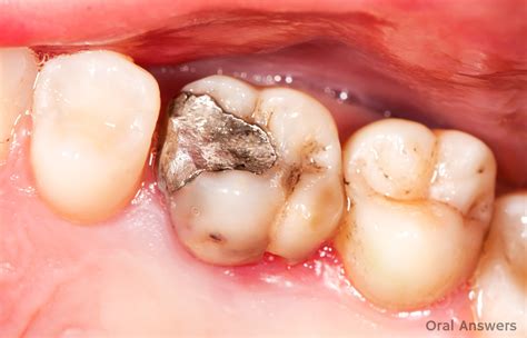 Allergies to Mercury In Silver Fillings Aren’t Common | Oral Answers