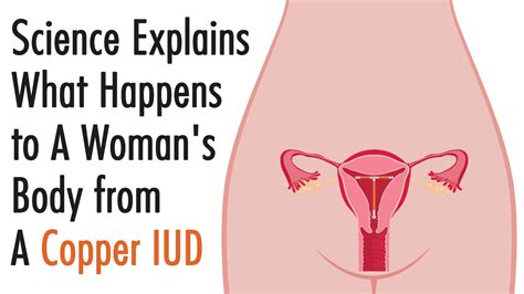 Copper Iud Removal Side Effects / Hormonal Iuds Wikipedia : It can be used by women of all ages ...