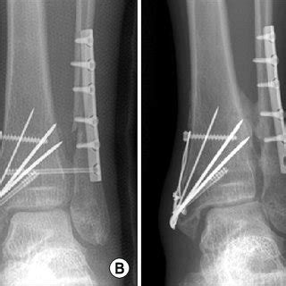 (PDF) Results of Syndesmotic Screw Fixation versus Posterior Malleolus Fixation in Syndesmotic ...