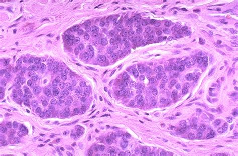 Pathology Outlines - Carcinoid tumor