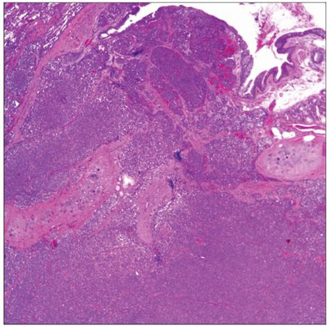 Neuroendocrine Carcinoma (Including Small Cell Carcinoma ...