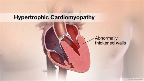 Hypertrophic Cardiomyopathy