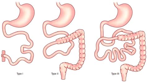 Medical Management of Short Bowel Syndrome and Nutritional Support | SpringerLink