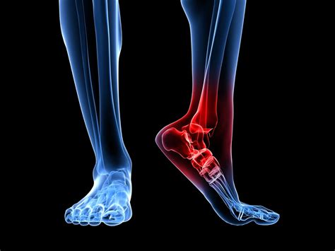 heel pain - runner's injury — LIGHTHOUSE FOOT & ANKLE CENTER