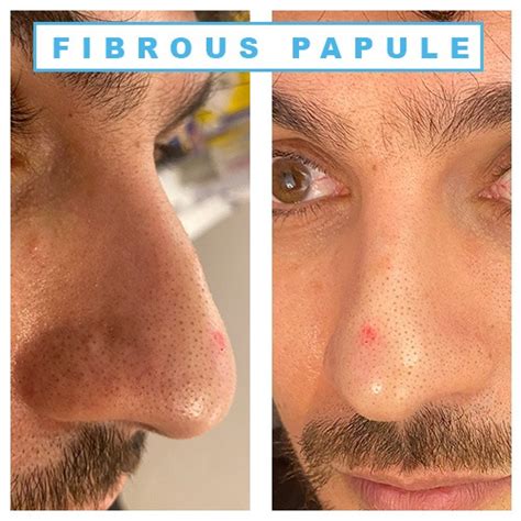 Fibrous papule | Fibrous papule of the nose | Fibrous papule treatment