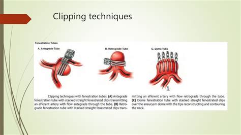 Aneurysm clips /clipology