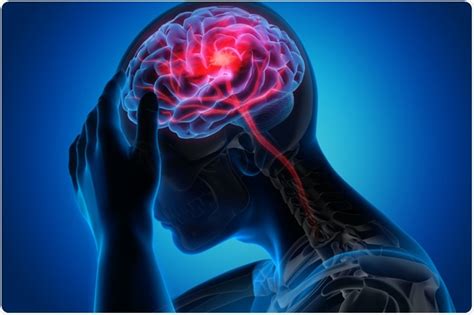 Frequent Headaches after a Traumatic Brain Injury