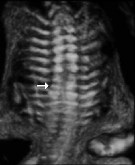 Prenatal Sonographic Diagnosis of Hemivertebrae - Wax - 2008 - Journal ...