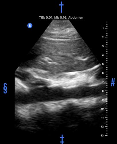 butterfly cloud ultrasound overview Flashcards | Quizlet