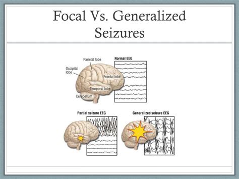 PPT - Epilepsy and Seizures in Adults: From Diagnosis to Treatment and Beyond PowerPoint ...