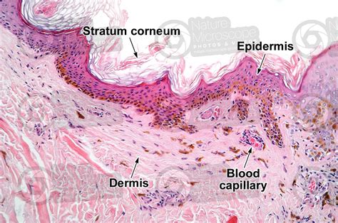 Man. Lentigo simplex. Lentigo. Vertical section. 125X - Nevus - Mammals - Integumentary system ...