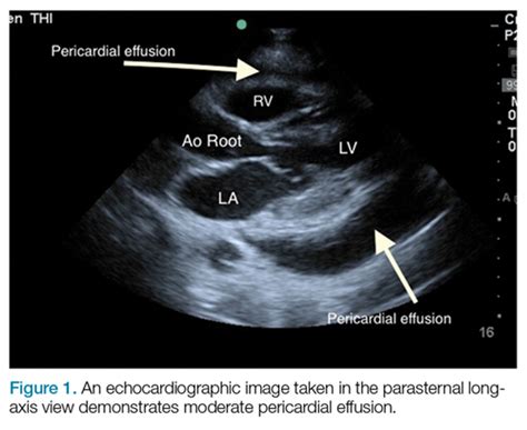 Emergency Ultrasound: Pericardial Effusion and Tamponade: Making the Diagnosis at Bedside With ...