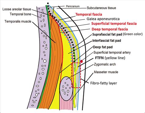 Suprafascial dissection for pterional craniotomy to preserve the ...