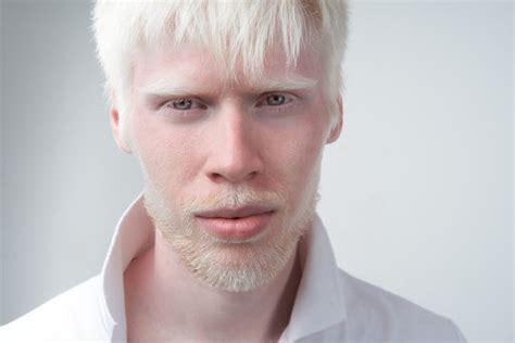 Albino Person Red Eyes