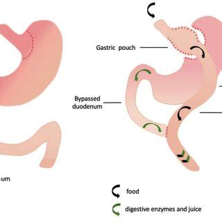 Roux-en-Y gastric bypass. | Download Scientific Diagram