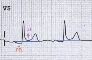 Pericarditis ECG Changes • LITFL • ECG Library Diagnosis