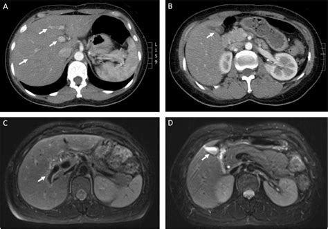 (A) Abdominal CT with contrast (venous phase) showed periportal edema... | Download Scientific ...