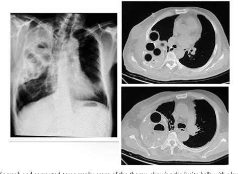 Figure 1 from Pleural infection 55 years after plombage for pulmonary tuberculosis | Semantic ...