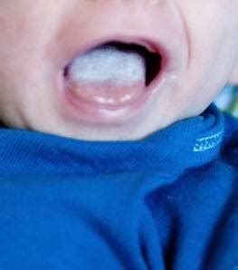 Is That Really Thrush on Your Baby’s Tongue? – Milk Matters Infant Feeding Solutions