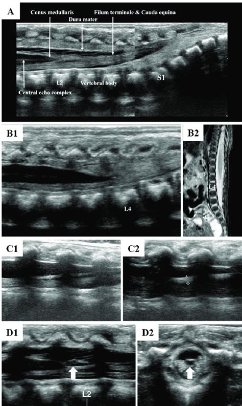 Conus Medullaris Ultrasound