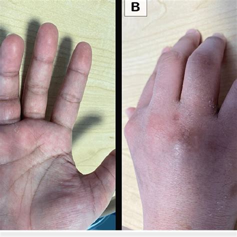 Patient's right hand on clinical examination. The ring (4th) finger is ...