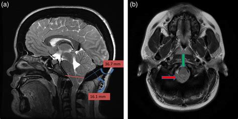 (a) Sagittal T2-weighted image showing cerebellar tonsillar herniation... | Download Scientific ...