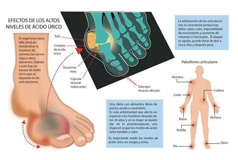 Gota y cálculos renales, las primeras manifestaciones del ácido úrico ...