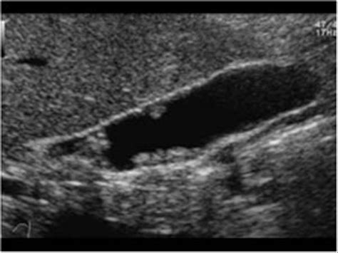 Abdomen and retroperitoneum | 1.2 Gallbladder and bile ducts : Case 1.2 ...