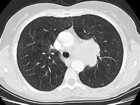 CXR and CT scans