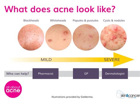 Different Types Of Acne