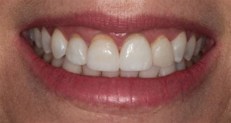 Crown Lengthening Before and After Pictures, MD Periodontics