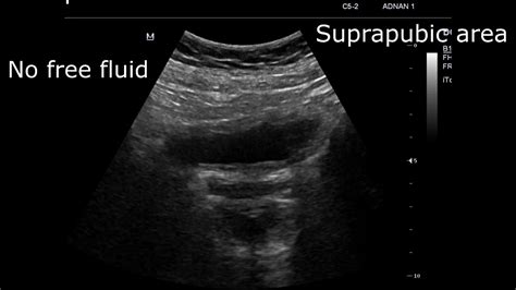 Aortic Dissection Ultrasound -Case 2- - YouTube