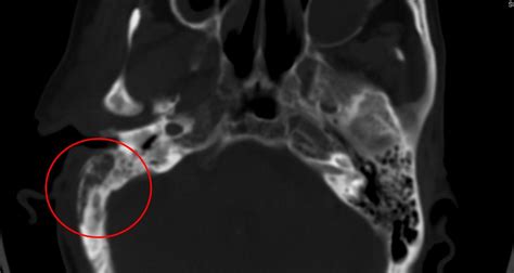 Malignant Otitis Externa - Clinical presentation, Diagnosis and Treatment