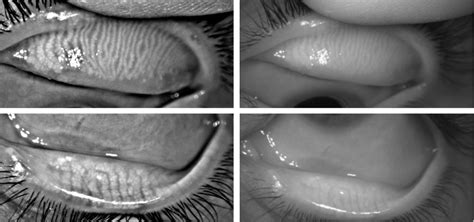 Assessing Eyelid Health in Dry Eye Patients